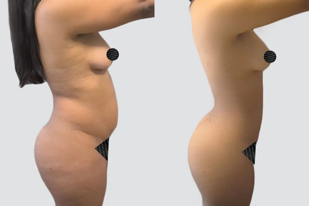 22 year old female lipo 360 before and after - 3 months post op