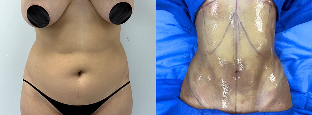 29 year old female lipo 360 before and after - 3 months post op