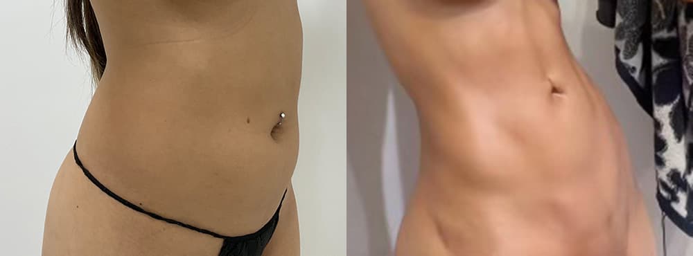 31 year old female lipo 360 before and after - 3 months post op