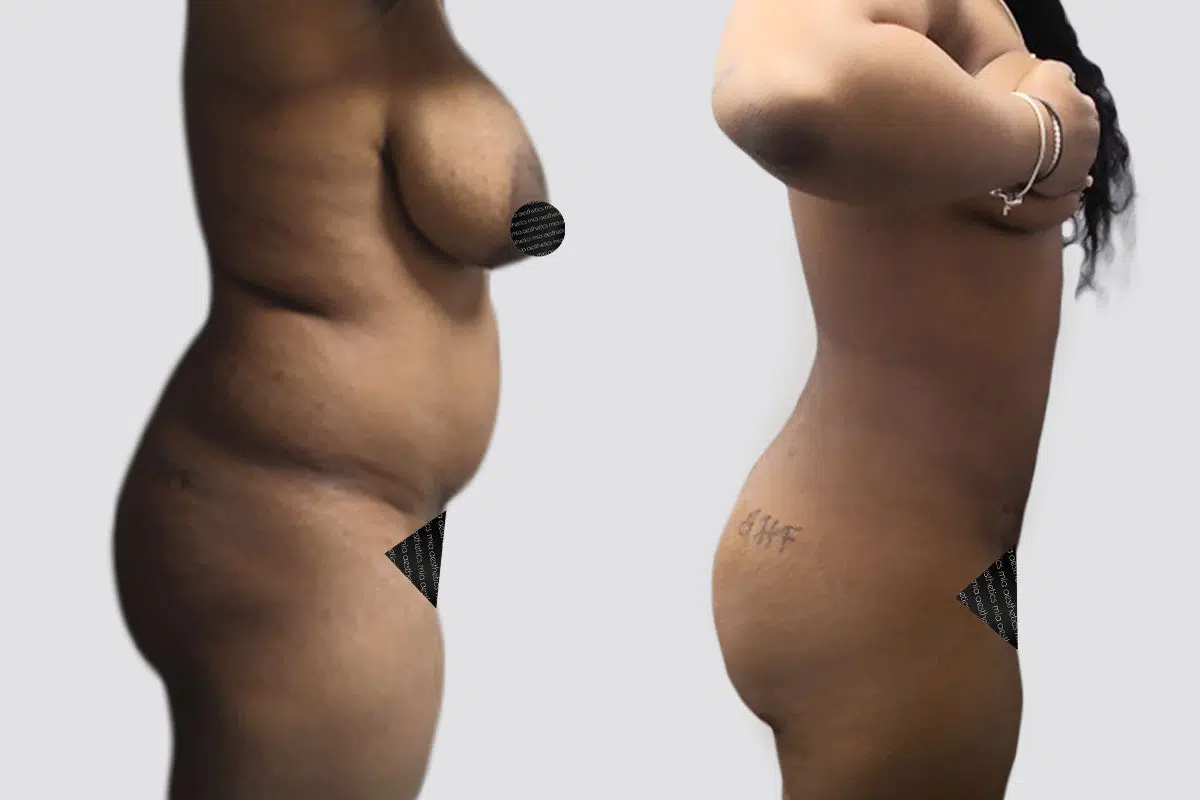 32 year old female lipo 360 before and after - 3 months post op