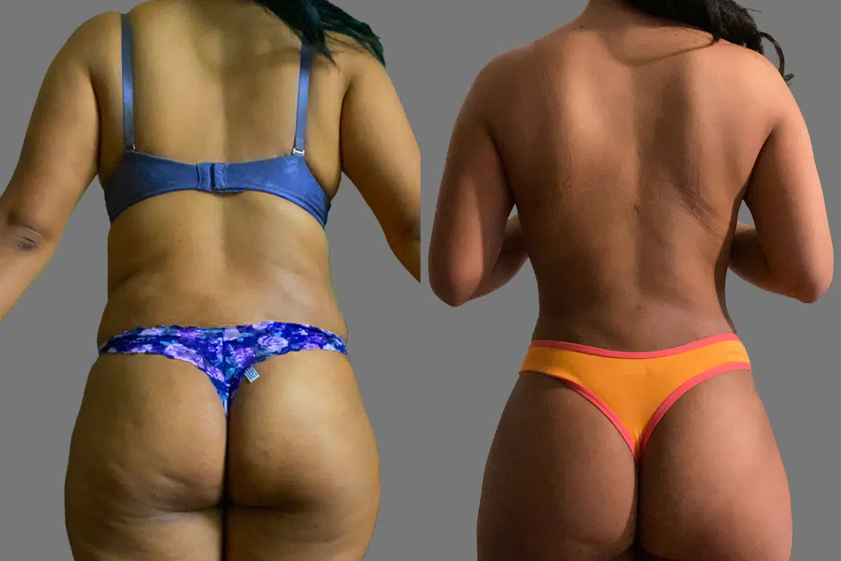 32 year old female lipo 360 before and after - 3 months post op