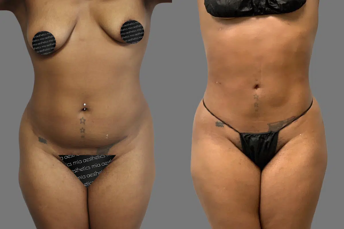 37 year old female lipo 360 before and after - 3 months post op