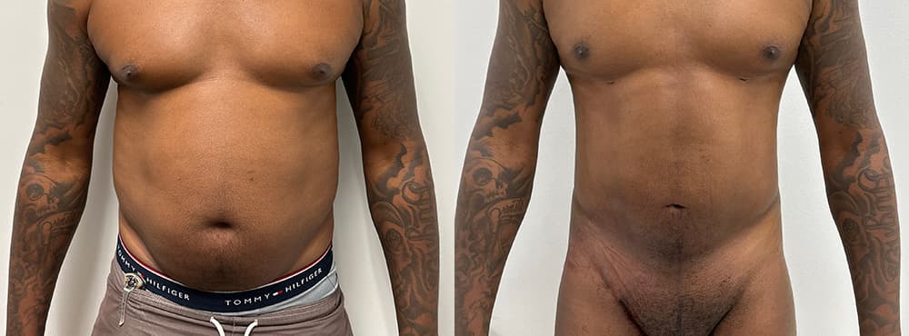 39 year old male lipo 360 before and after - 3 months post op