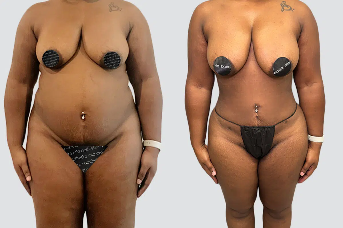 45 year old female lipo 360 before and after - 3 months post op