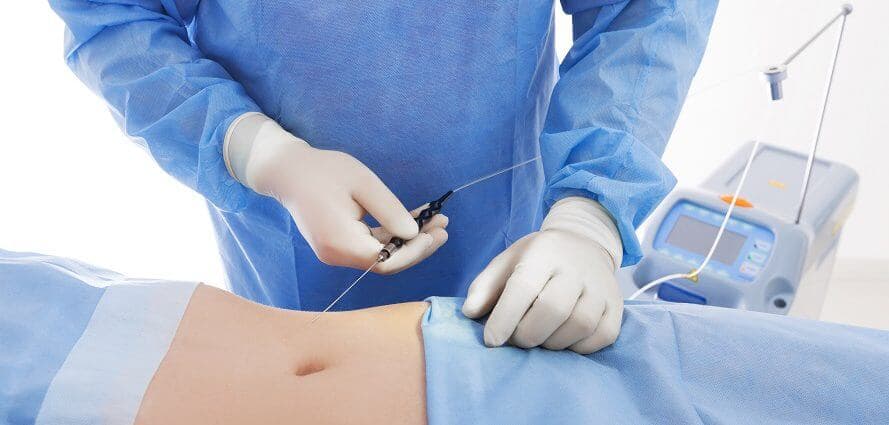 VASER Liposuction Results Example